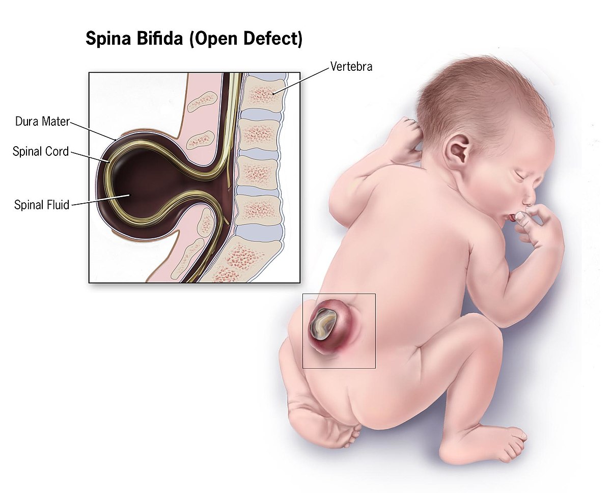 1200px Spina bifida