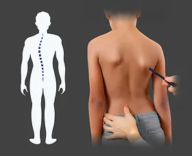 Cocuklarda Skolyoz terapisi