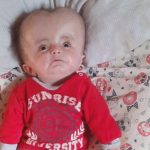 hidrosefali tedavisi