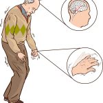 parkinson